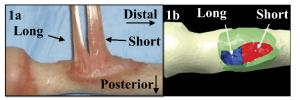 Distal Biceps Tendon Tears Pittsburgh PA