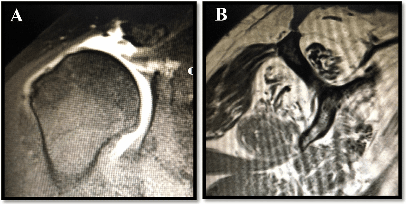 Irreparable Rotator Cuff Tears Treated in Pittsburgh, PA