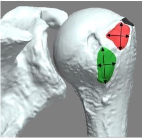 Rotator Cuff Humeral Footprints Pittsburgh PA