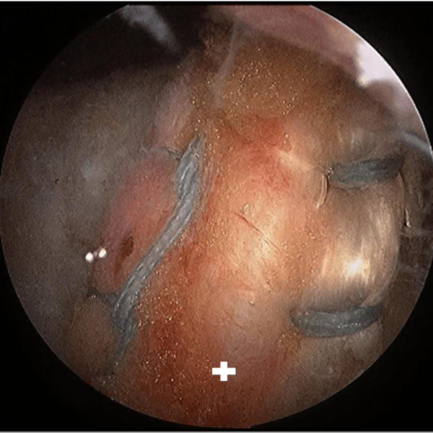 Irreparable Rotator Cuff Tears Treated